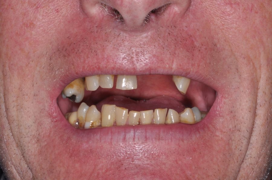 Teeth in a Day Procedure - Before - 3Dental Dublin & Limerick
